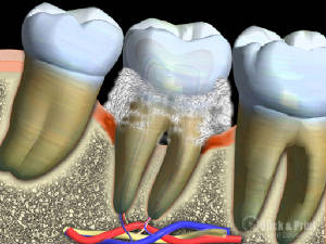 Image of Teeth | Long Island Periodontist