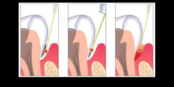 Laser Periodontics Video | Laser Periodontal Therapy in Long Island