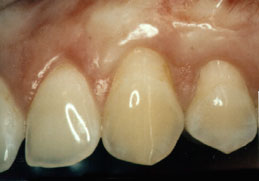 Root Coverage Graft Covers Recession | Periodontal Esthetics in Long Island, NY